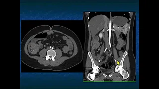 CT of Lymphoma: Involvement of the GI Tract - Part 2