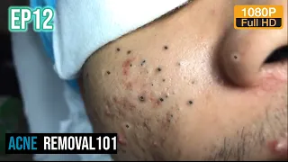 Cystic Acne Extraction 30mn , Blackheads Removal by ACNEREMOVAL101