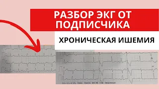 Разбор ЭКГ от подписчика.  Преходящая блокада левой ножки пучка Гиса?