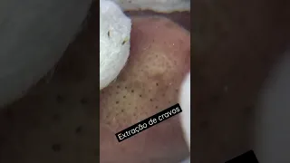 Limpeza de Pele perfeita | Extração de Cravos | Esteticista explica