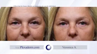 Plexaderm - Say Goodbye to Wrinkles!