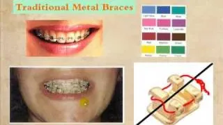 Braces different types and choices by Berwyn and Oak Lawn, IL orthodontist