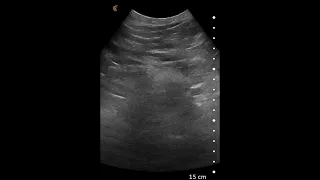 Abdominal Aortic Aneurysm (AAA) - Ultrasound Image Interpretation