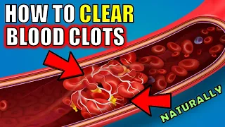 How to Clear Blood Clots Naturally