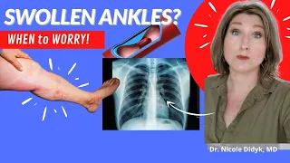 When to see a doctor right away for swollen legs!  GERI-Minute #178