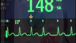 Synchronized Cardioversion with the HeartStart MRx monitor/defibrillator