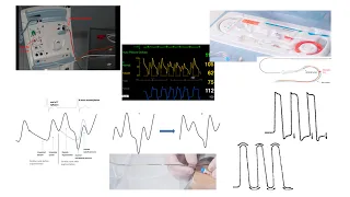 Balloon pump: hemodynamics, troubleshooting, technical tips- Elias Hanna