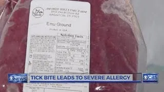 UNC doctor calls Alpha-gal meat allergy 'tremendously underdiagnosed'