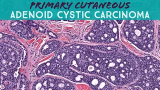 Adenoid cystic carcinoma of skin (AIP France 2021 - bonus case) dermpath dermatology pathology