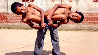 MOST UNUSUAL Conjoined Twins You Won't Believe Exist!