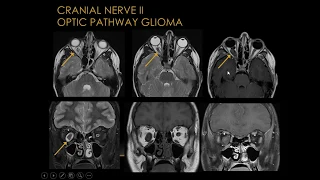 Cranial Nerves MRI Diagnostics - Part 1 - [Basic Radiology]