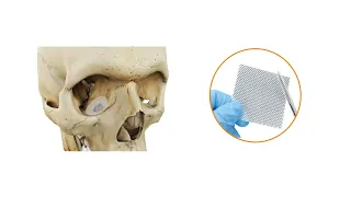 Osteomesh Orbital Floor Reconstruction