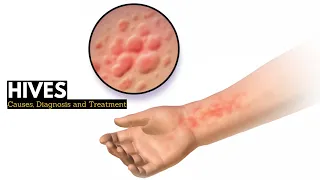 HIVES, Causes, Signs and Symptoms, Diagnosis and Treatment.