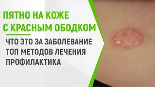 Пятно на коже с красным ободком