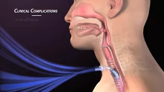 Clinical Complications of Tracheostomy