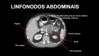 IMAGINOLOGIA LINFONODOS ABDOME SUPERIOR E PELVE