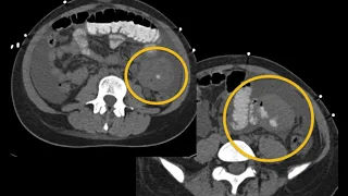 MDCT of the Small Bowel Tumors: Detection and Classification Part 2