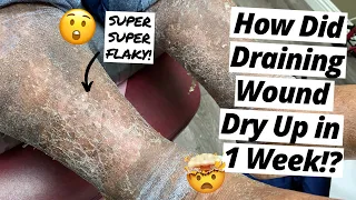 HOW Did This Draining Wound Dry Up In 1 Week?! *SUPER FLAKY SKIN*