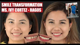 Fake Smile to Natural Beautiful Apostolified Smile | Apostol Dental Philippines