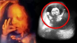 10 Babies Caught Doing Strange Things On Ultrasound!