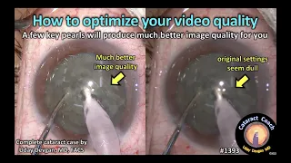 CataractCoach 1393: how to optimize your video quality