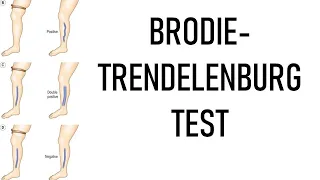 Brodie-Trendelenburg Test (examination of varicose veins)