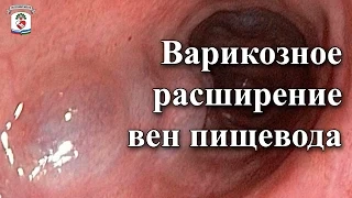 "На приеме у врача" Выпуск 8 - Варикозное расширение вен пищевода