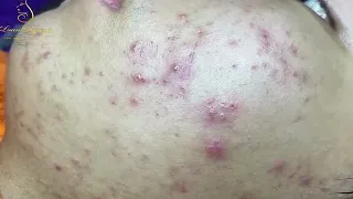 Loan Nguyen Acne Treatment 15567576h