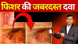 फिशर की सबसे अच्छी दवा Fissure Treatment #fissuretreatment #fissure #piles