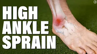 High Ankle Sprain | Syndesmosis Injury (Evaluation | Education | Exercises)