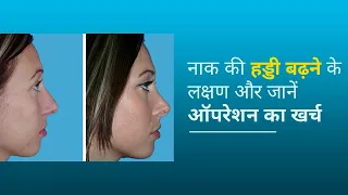 Naak ki Haddi ka Operation | Septoplasty | नाक की हड्डी बढ़ने के लक्षण और जानें ऑपरेशन का खर्च