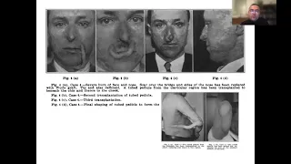 History of Reconstructive Microsurgery, From East Grinstead to the Present Day