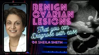 BENIGN OVARIAN LESIONS THAT YOU CAN DIAGNOSE WITH EASE || DR SHEILA SHETH || SONOBUZZ REWIND