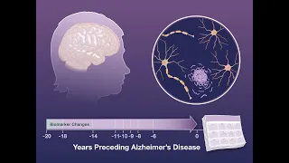 Biomarker Changes Preceding Alzheimer’s Disease | NEJM
