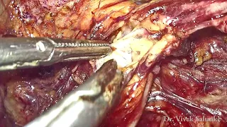 Retroperitoneal Pelvic anatomy Discussed in radical Hysterectomy