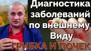 Грибок - почки . Диагностика заболеваний по внешним признакам . @Duiko ​