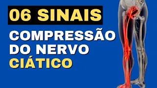 06 Sintomas de Compressão do Nervo Ciático