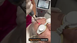 Pigmentation removal with Fotona laser | Newcastle Cosmetic Doctor | Patient first laser treatment