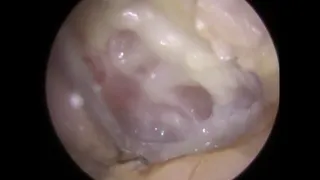 Infected Debris and Thick Discharge Microsuction from Ear Canal and off Eardrum - #348