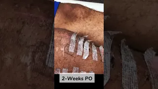 Remove Steri Strips After Knee Surgery