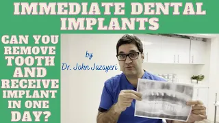 Immediate Dental Implants: Single Visit Tooth Removal + Implant Placement