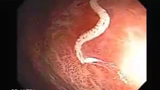 1new Parasites   Whipworm Found in Human Colon x264