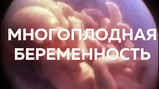 Многоплодная Беременность. Бихориальная и Монохориальная Двойня