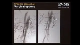 How-I-Do-It: My Approach to Chronic Type B Dissections