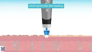 Micro-Needling Explained: Animation