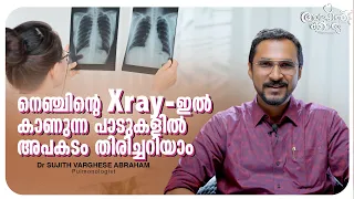 നെഞ്ചിന്റെ X-ray യിൽ അപകടം തിരിച്ചറിയാം l  Chest X-ray Danger Signs l Dr Sujith Varghese l