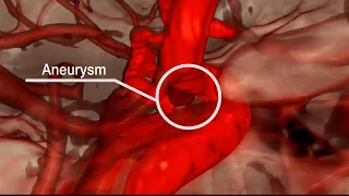 Mayo Clinic Minute - The difference in brain aneurysms