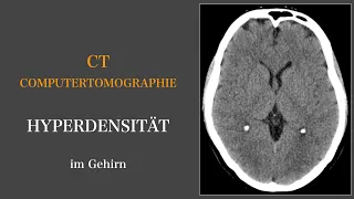 Computertomographie I Hyperdensität im Gehirn I Neuroradiologie I Brain & Synapse