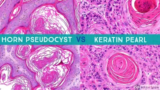 Keratin Pearl (SCC) vs Horn Pseudocyst (SK) (aka "pseudohorn cyst")