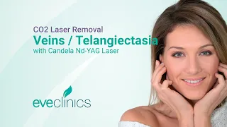 Vein and Telangiectasia Removal with Candela Nd:YAG Laser | Eve Clinics Specialist Treatment